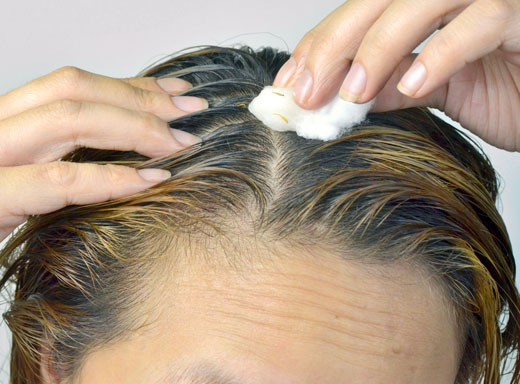 Caspa: causas, prevención y de una enfermedad de la pielpelo | cabello | capilar | caspa | cuero cabelludo | peluqueria | sebáceas | dermatitis seborreica | | dermatologia | | COSMETOLOGAS.COM - Belleza y estética ...