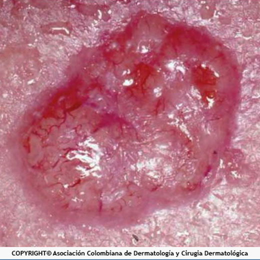 Carcinoma basocelular