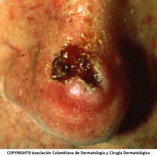 Carcinoma escamocelular