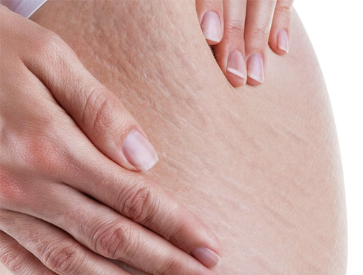 CELULITIS