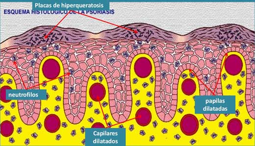 Esquema histológico de la psoriasis