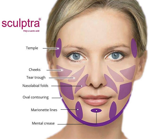 Estimulação de colágeno e rejuvenescimento com Sculptra