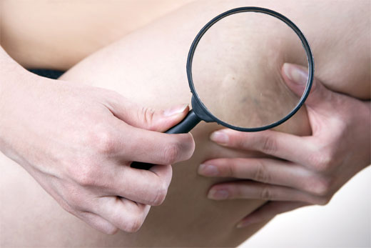 CELULITIS
