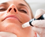 Microneedling: mesoterapia que abre mais de 1.000 microcanais por segundo