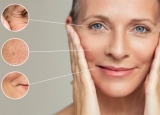 Estimulao de colgeno e rejuvenescimento com Sculptra