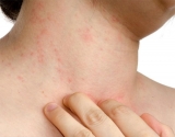 Psorase e sistema imunolgico